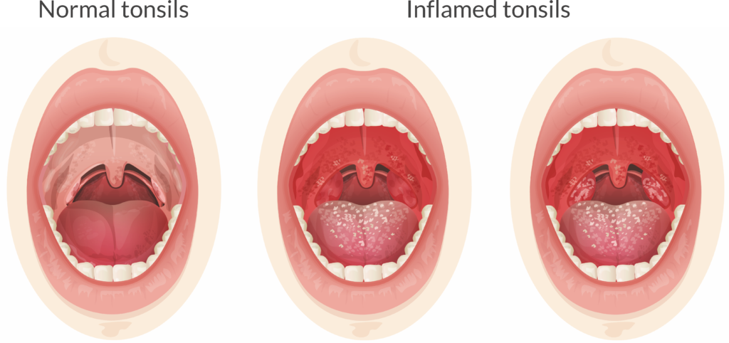 Tonsils in Adults - Ear Surgeon