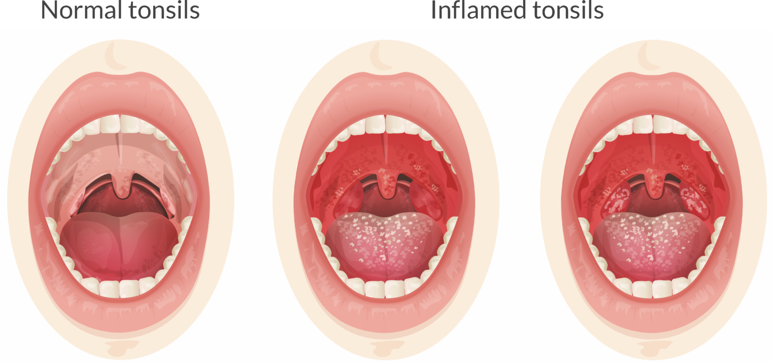 Tonsils - Ear Surgeon