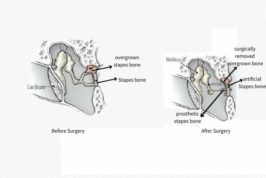 stapedectomy treatment