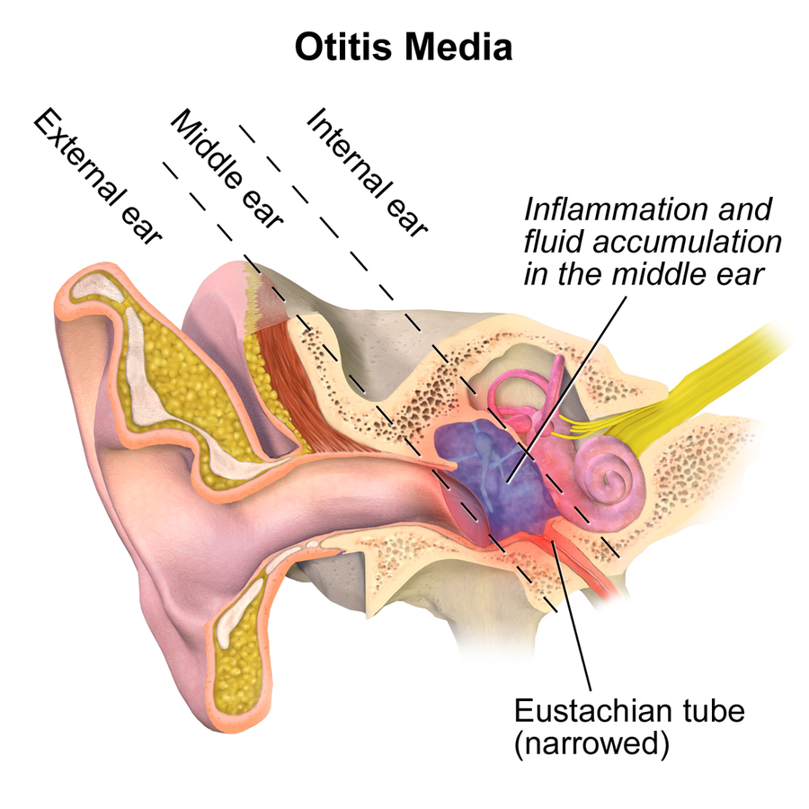 Otitis media surgery by Earsurgeon Dr. Shree Rao