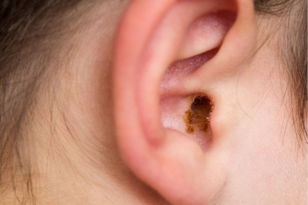 Understanding earwax and its purpose