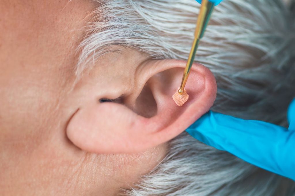 Understanding and Treating Auricular Seroma