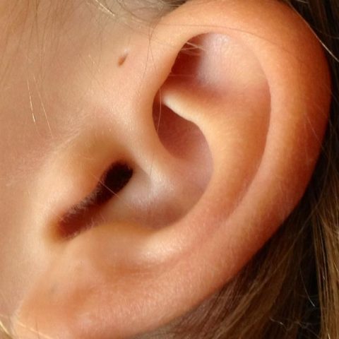 Preauricular_sinus_and_cyst