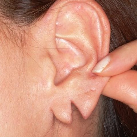 ear-lobule