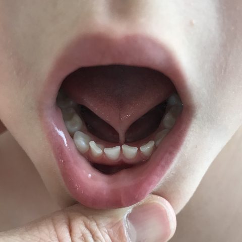tongue-tie